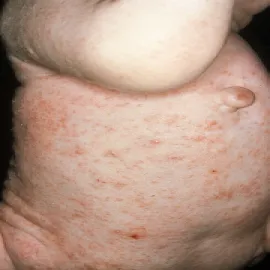 Charakterystyczne zmiany skórne świerzb