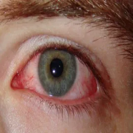 Chlamydia oko
