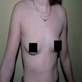 Choroba świerzb u nastolatki