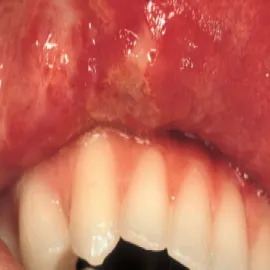 Choroba Behçeta na wardze górnej