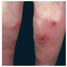 Choroba Behçeta objawy na nogach