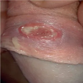 Choroba Behçeta wrzód na genitaliach