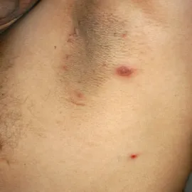 Choroba Behçeta wysypka na skórze