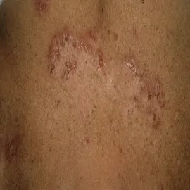 Choroba Haileya-Haileya na skórze