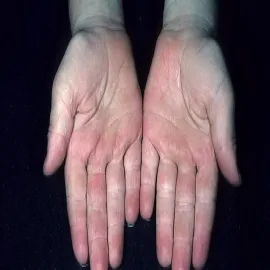 Choroba Kawasaki objawy na dłoniach