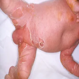 Choroba Rittera u niemowląt objawy