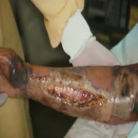 Choroba gangrena zgorzel właściwa 