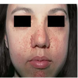 Choroba gruczolak łojowy