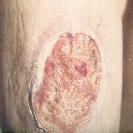 Choroba kiła wrzód 