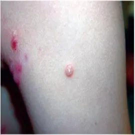 Choroba mięczak zakaźny 