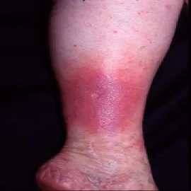 Choroba wyprysk podudzi 