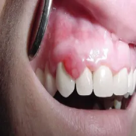 Choroby dziąseł nadziąślak 