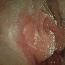 Choroby kobiecych narządów płciowych rogowacenie białe sromu 