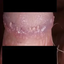 Choroby męskie grudki perliste