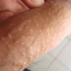 Choroby męskie zdjęcia plamki fordyce'a