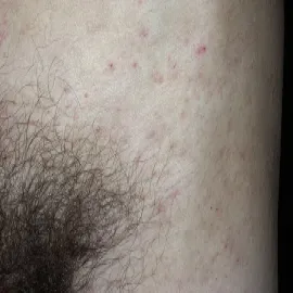 Choroby miejsc intymnych świerzb