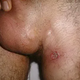 Choroby okolic intymnych choroba Behçeta 