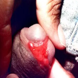 Choroby opis zdjęcia prącia ziarniniak pachwinowy 