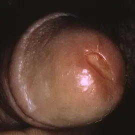 Choroby opis zdjęcia rzeżączka