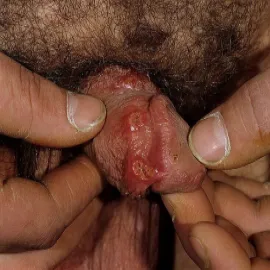 Choroby penisa wrzód weneryczny