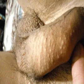 Choroby penisa zdjęcia plamki fordyce'a