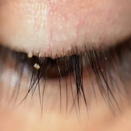 Choroby powiek nużyca