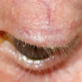 Choroby powiek oczu zdjęcia zapalenie brzegów powieki 