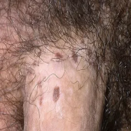 Choroby prącia obrazy grudkowatość bowenoidalna 