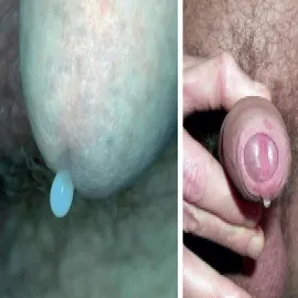 Choroby przenoszone drogą płciową chlamydia