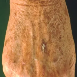 Choroby skóry dłoni rogowacenie słoneczne