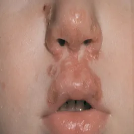 Choroby skóry liszajec u dziecka