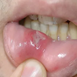 Choroby ust warg zdjęcia choroba Behçeta 