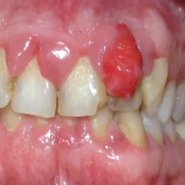 Choroby w jamie ustnej nadziąślak 