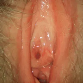 Choroby warg sromowych leukoplakia sromu