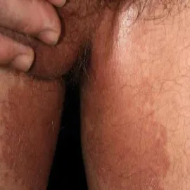 Ciemnobrunatna plama rumieniowa łupież rumieniowy 