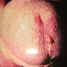 Clamydia u mężczyzn objawy