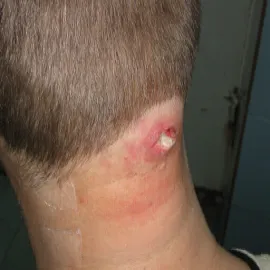 Czyrak u mężczyzny na karku