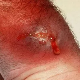 Czyrak z ropą  krwią