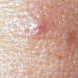 Demodex brevis nużeniec