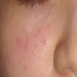 Demodex folliculorum nużeniec