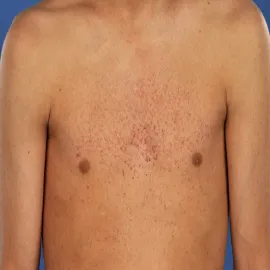 Drobna wysypka skórna choroba Fabry'ego