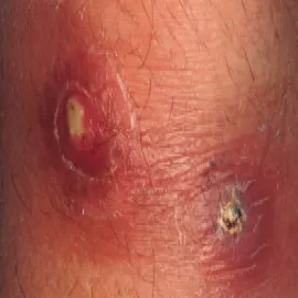 Ecthyma gronkowiec złocisty