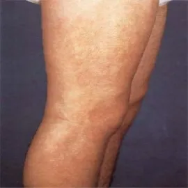 Eozynofilowe zapalenie powięzi