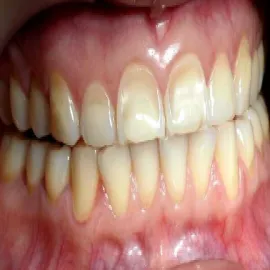 Erozja szkliwa zębów 