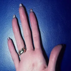 Erytromelalgia objawy na dłoni 