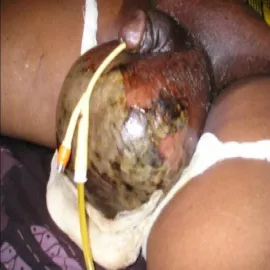 Gangrena moszny choroba zgorzel Fourniera 