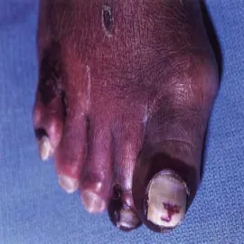 Gangrena właściwa na palcu