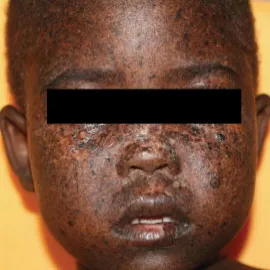 Genetyczna choroba genodermatoza 