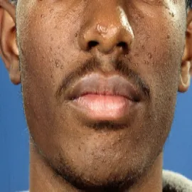 Gruczolak łojowy na twarzy