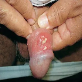 Grudki na penisie wrzód weneryczny